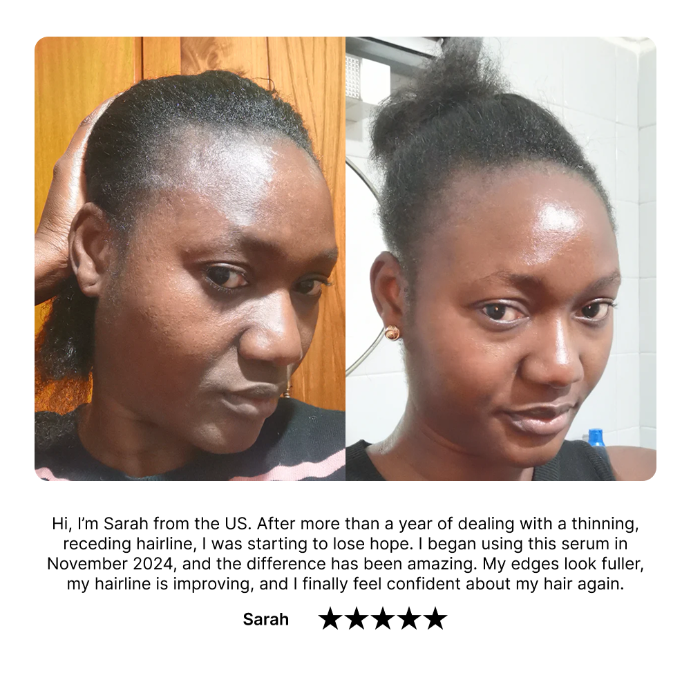 Noirélle Hair Growth Serum | 1 + 1 FREE