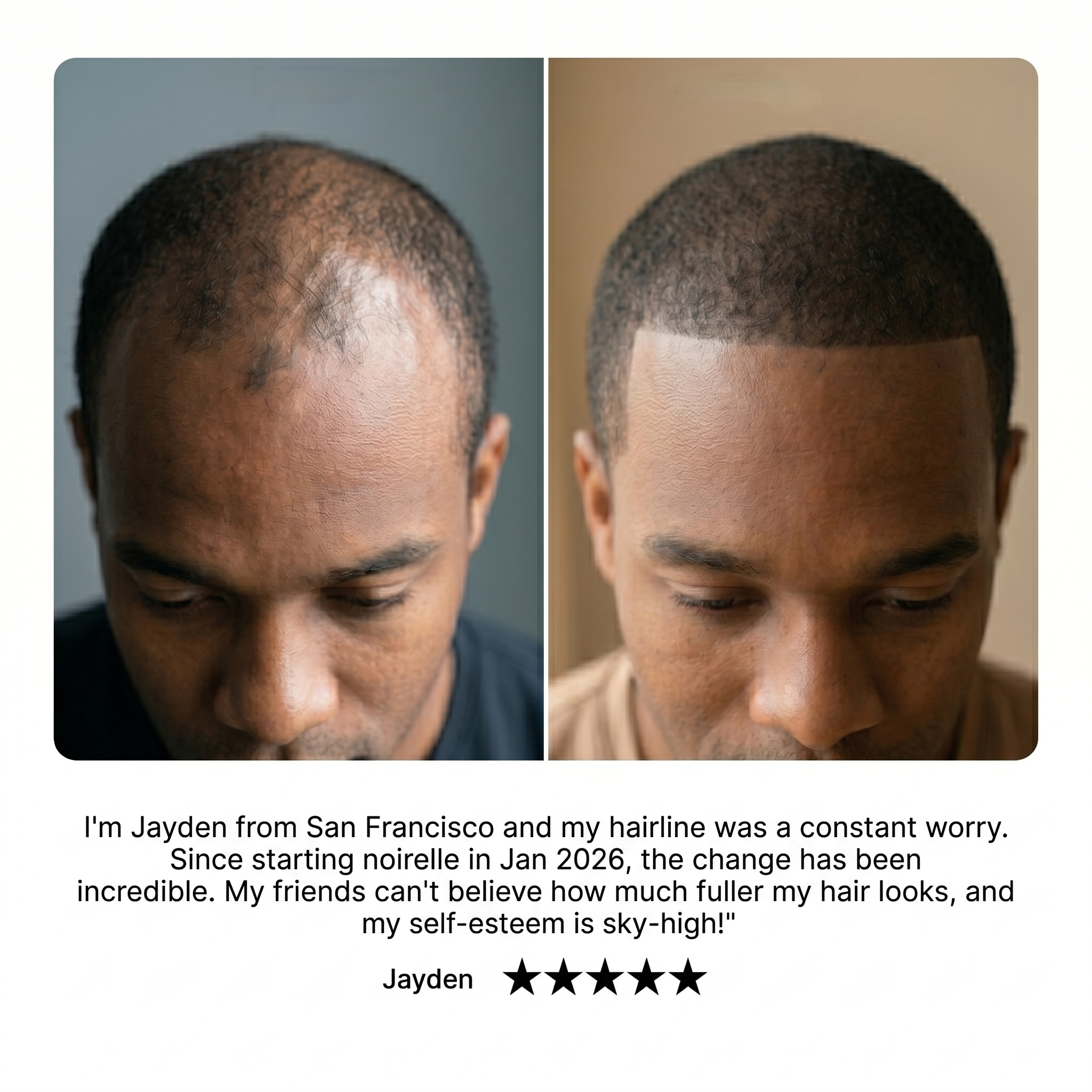 Noirélle Hair Growth Serum | 1 + 1 FREE
